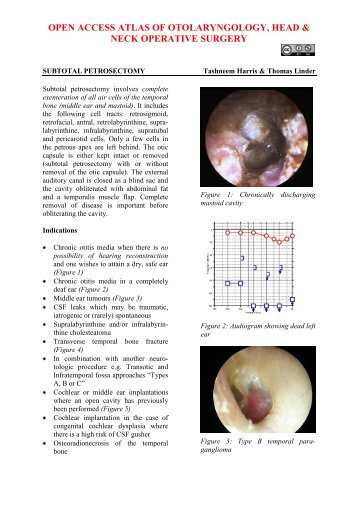 Subtotal petrosectomy - Vula - University of Cape Town