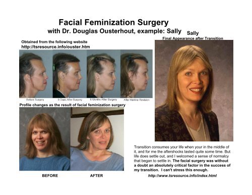 Facial Feminization Surgery and The Standards of Care
