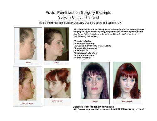Facial Feminization Surgery and The Standards of Care