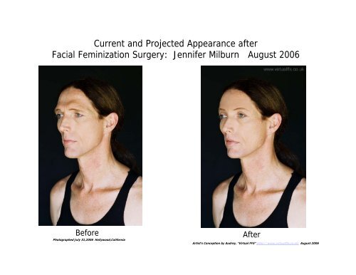 Facial Feminization Surgery and The Standards of Care