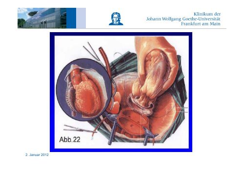 Herzinsuffizienz, VAD, Herztransplantation - FINeST