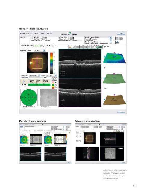 CIRRUS photo Certainty meets versatility - Carl Zeiss Meditec