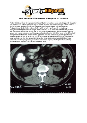 DEV APPANDÄ°SÄ°T-MUKOSEL ameliyat ve BT ... - TavsiyeEdiyorum