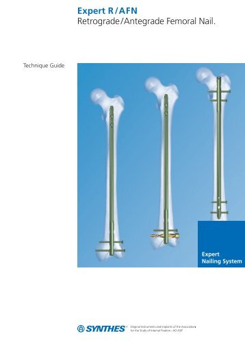 Expert R/AFN Retrograde /Antegrade Femoral Nail. - Osteosyntese