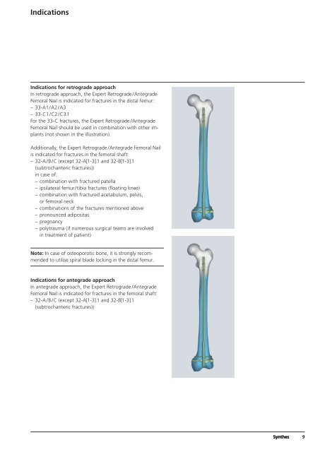 Expert R/AFN Retrograde /Antegrade Femoral Nail. - Osteosyntese