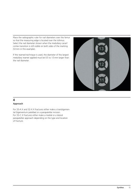 Expert R/AFN Retrograde /Antegrade Femoral Nail. - Osteosyntese