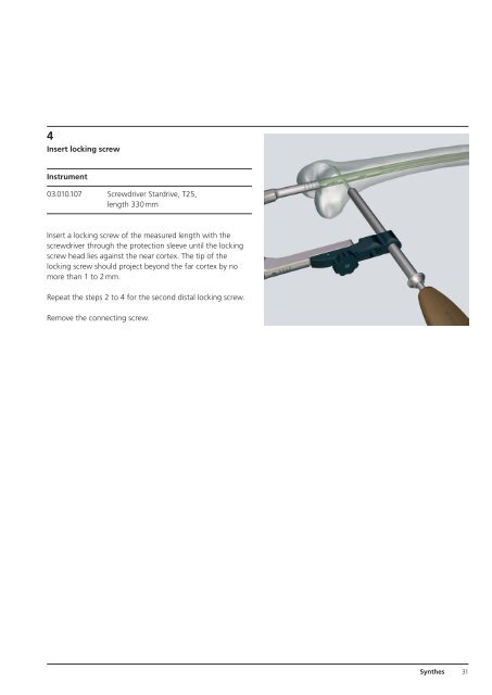 Expert R/AFN Retrograde /Antegrade Femoral Nail. - Osteosyntese