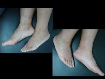 Dermatitis por contacto en Ã¡rea del calzado - PIEL-L Latinoamericana