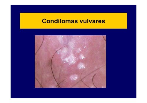 CarcinogÃ©nesis por HPV