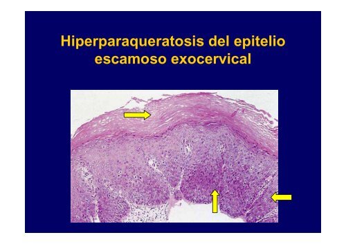 CarcinogÃ©nesis por HPV