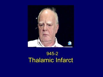 Thalamic Infarct