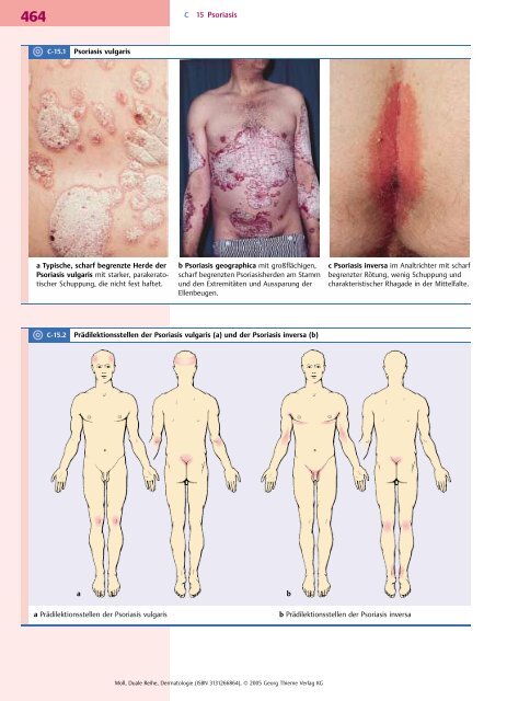 a b C 15 Psoriasis