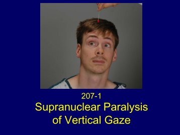 Supranuclear Paralysis of Vertical Gaze