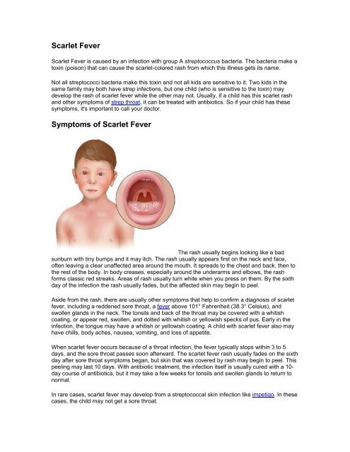 Scarlet Fever Cure  Side Effects of Scarlet Fever