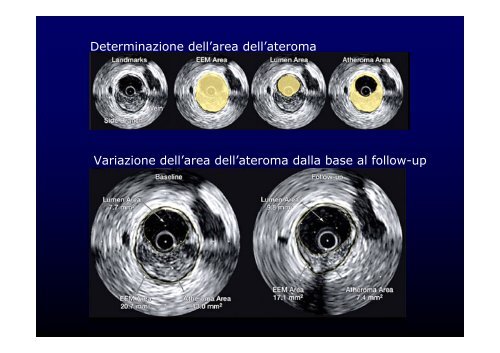 La cardiopatia ischemica - Cuorediverona.it