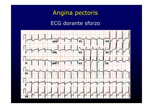 La cardiopatia ischemica - Cuorediverona.it