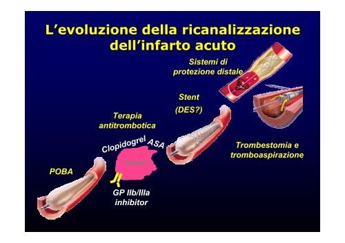 La cardiopatia ischemica - Cuorediverona.it