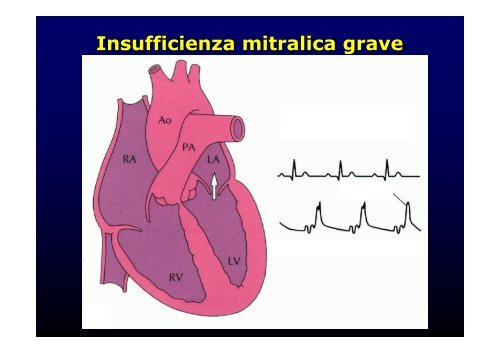 La cardiopatia ischemica - Cuorediverona.it