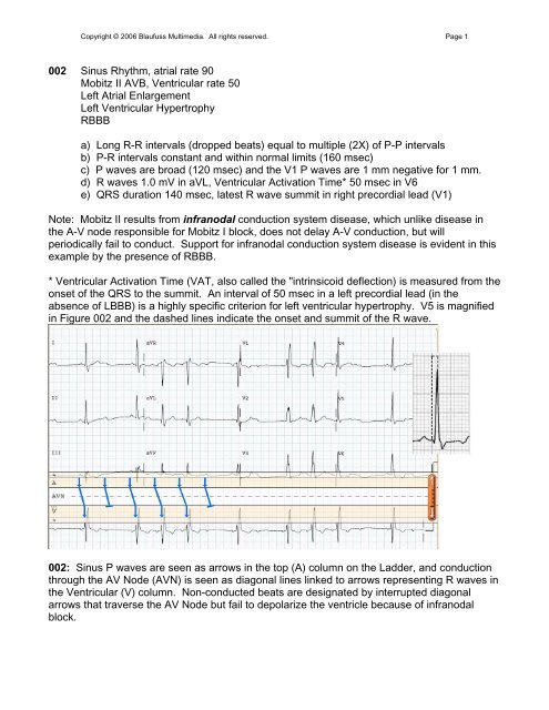 002 Sinus Rhythm, atrial rate 90 Mobitz II - Blaufuss Multimedia