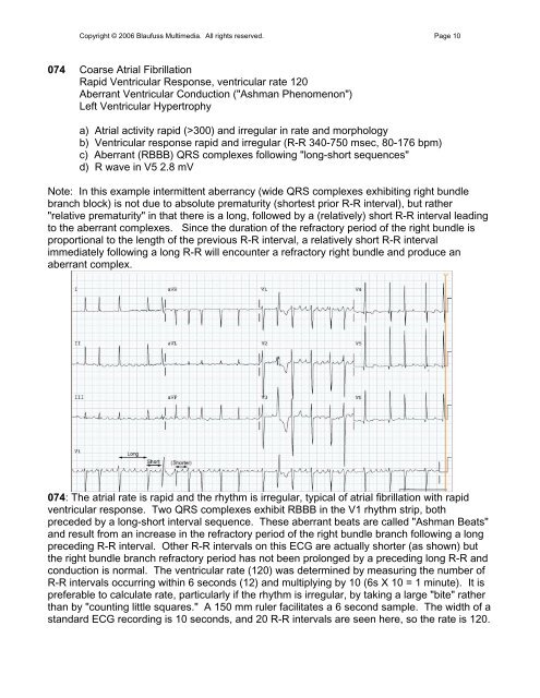 002 Sinus Rhythm, atrial rate 90 Mobitz II - Blaufuss Multimedia