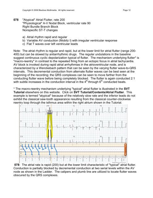 002 Sinus Rhythm, atrial rate 90 Mobitz II - Blaufuss Multimedia