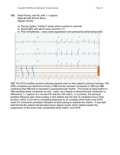 002 Sinus Rhythm, atrial rate 90 Mobitz II - Blaufuss Multimedia