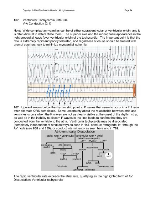 002 Sinus Rhythm, atrial rate 90 Mobitz II - Blaufuss Multimedia