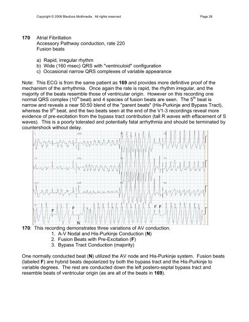 002 Sinus Rhythm, atrial rate 90 Mobitz II - Blaufuss Multimedia