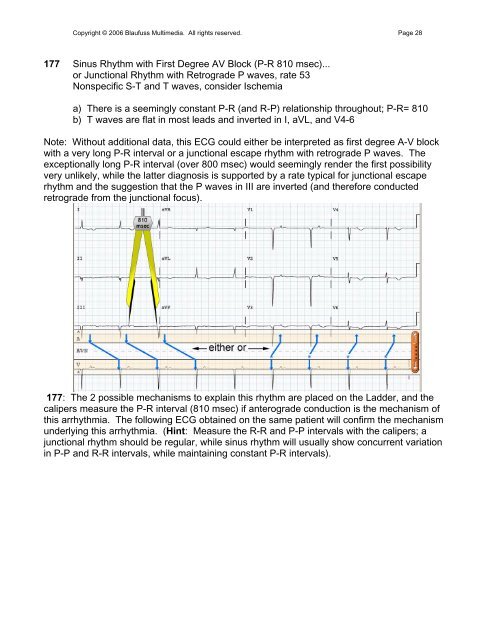 002 Sinus Rhythm, atrial rate 90 Mobitz II - Blaufuss Multimedia