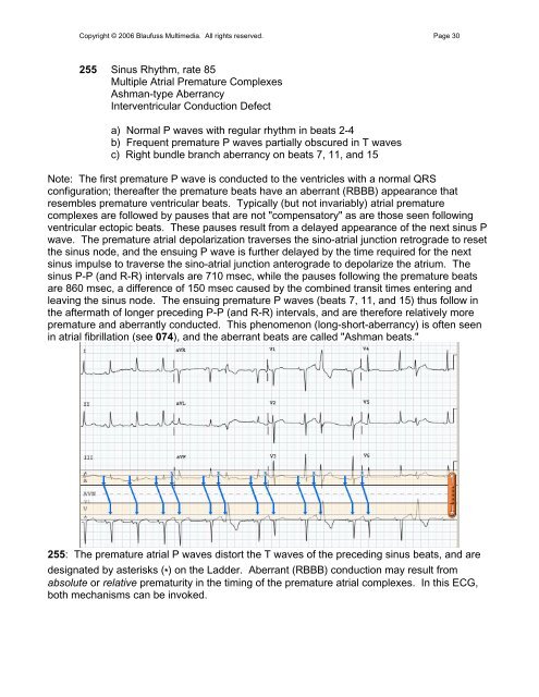 002 Sinus Rhythm, atrial rate 90 Mobitz II - Blaufuss Multimedia