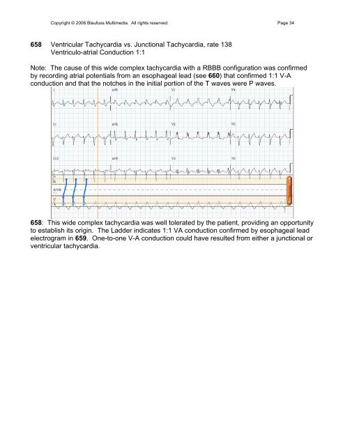 002 Sinus Rhythm, atrial rate 90 Mobitz II - Blaufuss Multimedia