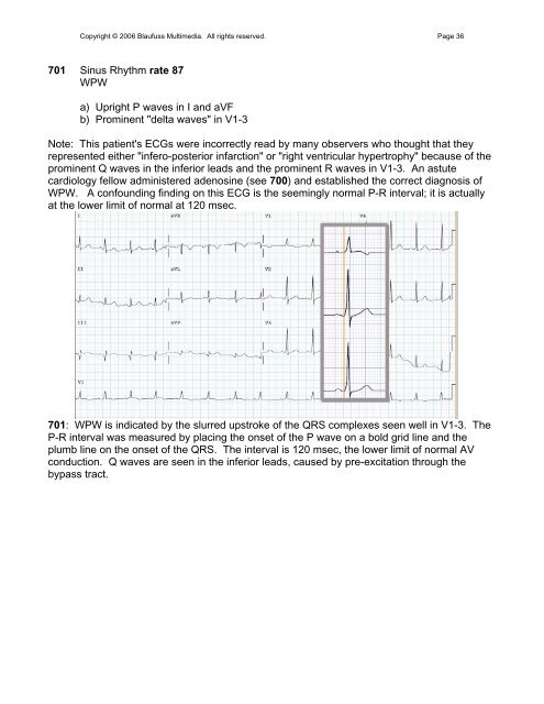 002 Sinus Rhythm, atrial rate 90 Mobitz II - Blaufuss Multimedia