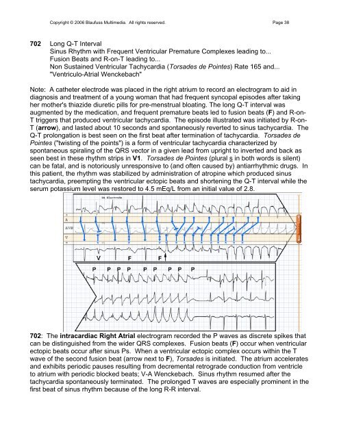 002 Sinus Rhythm, atrial rate 90 Mobitz II - Blaufuss Multimedia