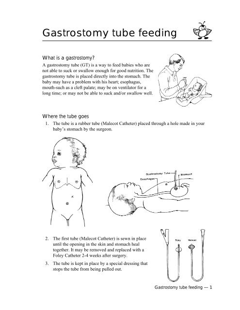 Gastrostomy tube feeding - Biliaryatresia.org