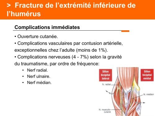 Fracture des mÃ©tacarpiens