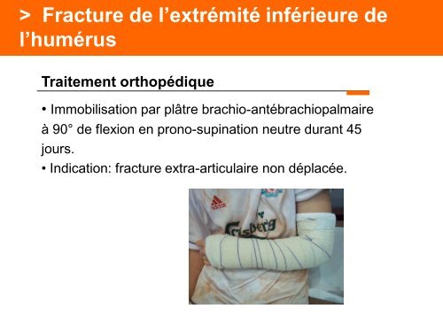 Fracture des mÃ©tacarpiens