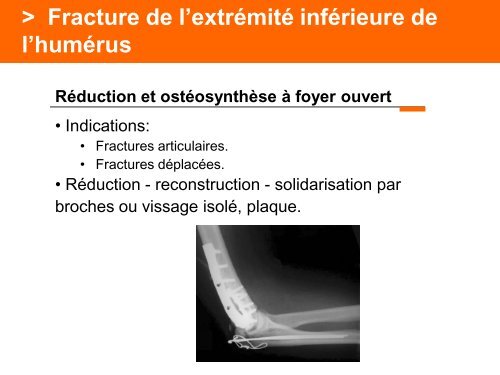 Fracture des mÃ©tacarpiens