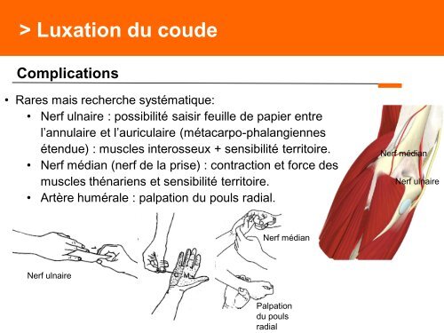 Fracture des mÃ©tacarpiens