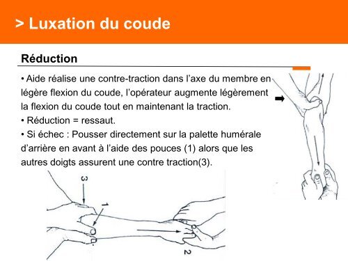 Fracture des mÃ©tacarpiens