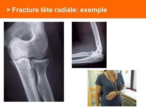 Fracture des mÃ©tacarpiens