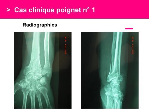 Fracture des mÃ©tacarpiens