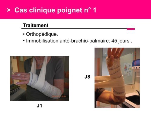 Fracture des mÃ©tacarpiens