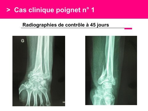 Fracture des mÃ©tacarpiens