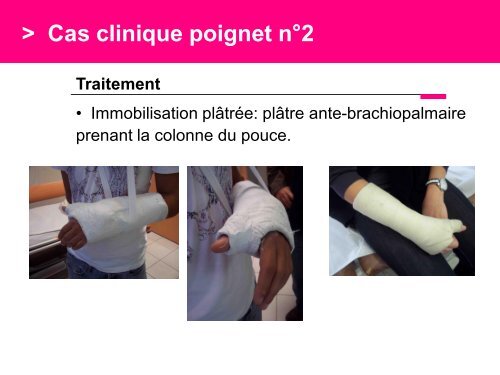 Fracture des mÃ©tacarpiens