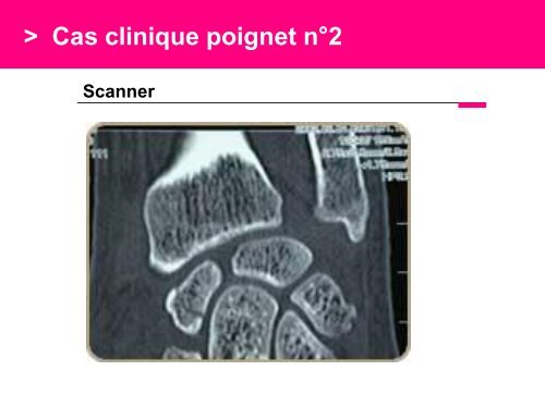 Fracture des mÃ©tacarpiens