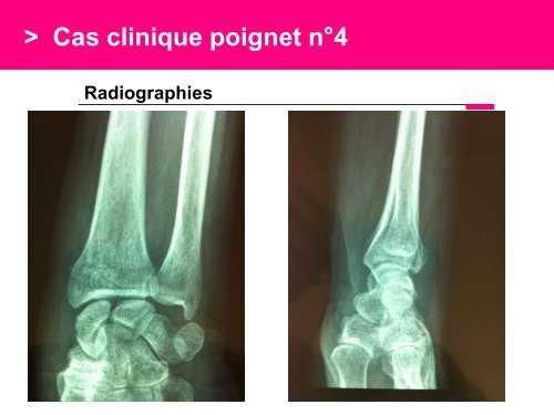 Fracture des mÃ©tacarpiens