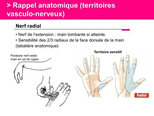 Fracture des mÃ©tacarpiens