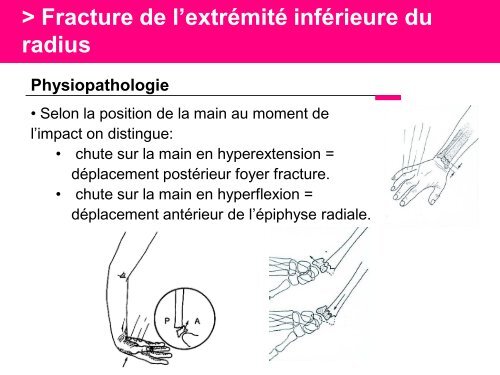 Fracture des mÃ©tacarpiens