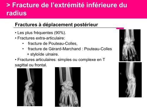 Fracture des mÃ©tacarpiens