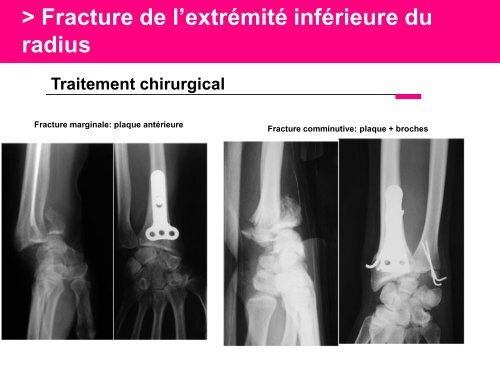 Fracture des mÃ©tacarpiens